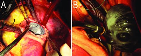 Intraoperative Photographs Of An Open Heart Surgery Of A 76 Year Old