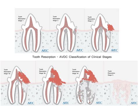 Indeed, resorptive lesions are startlingly common. Advanced Veterinary Dental Imaging in Athy, Portlaoise ...