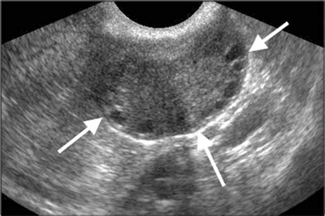 Ovarian Stromal Hyperthecosis Brown 2009 Journal Of Ultrasound In