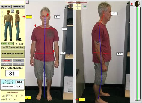 Case study: Lower back pain and poor posture - Spine and ...
