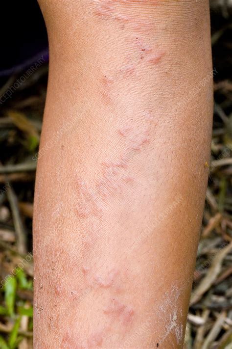 Cutaneous Larva Migrans Stock Image M Science Photo Library