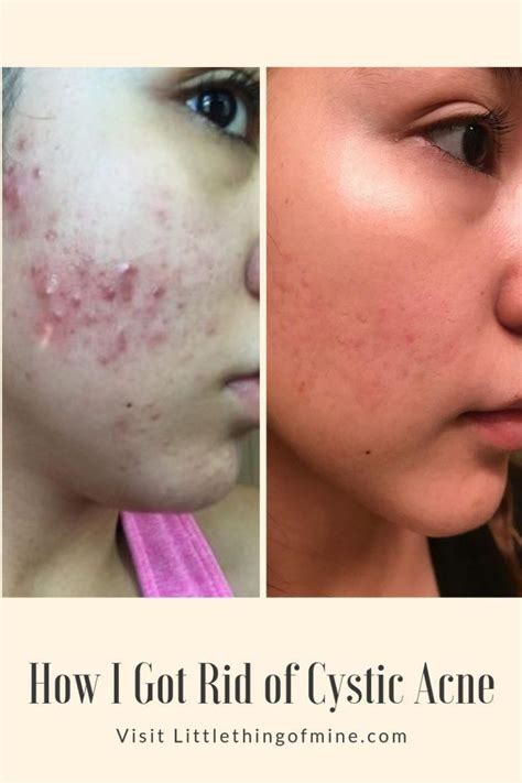 Little Thing Of Mine How I Got Rid Of Cystic Acne Hormonal Acne