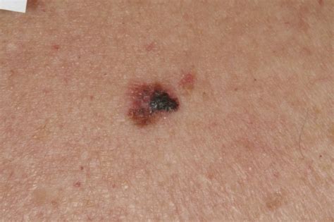 Melanoma Skin Cancer Signs