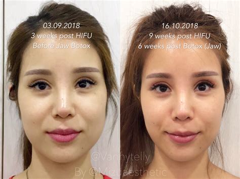 3 Things To Know Before Having Hifu Treatment After Botox Justinboey