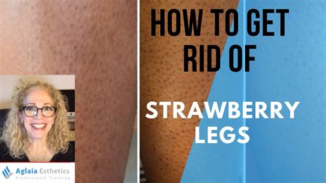 How To Get Rid Of Strawberry Legs Naturally Youtube