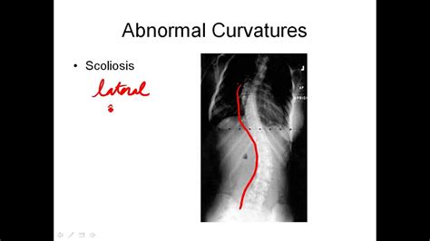 26 Abnormal Curvatures Of The Spine And Lifespan Changes Youtube