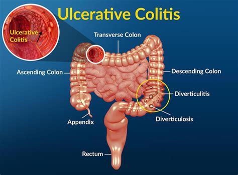 Ulcerative Colitis Causes Symptoms Diet Surgery Treatment