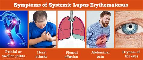 Systemic Lupus Erythematosus Sle Causes Symptoms Treatment Hot Sex