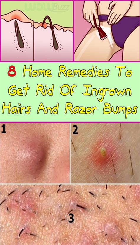 8 Home Remedies To Get Rid Of Ingrown Hairs And Razor Bumps Skin Bumps Treat Ingrown Hair