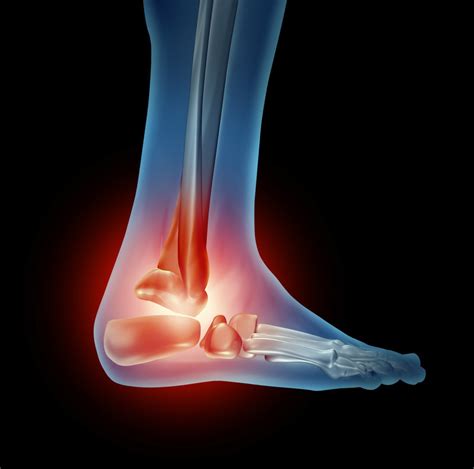 Stiffness Of Ankle Cause Symptoms Treatment Exercise Samarpan P