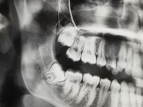 My Wisdom Tooth Is Growing Sideways Rradiology
