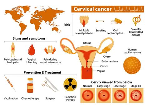 Cervical Cancer Symptoms Warning Signs Of Cervical Cancer