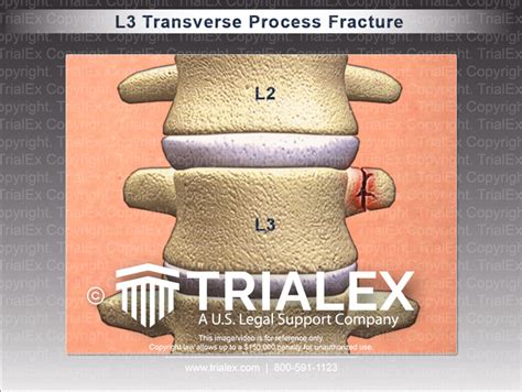 L L Transverse Process Fracture