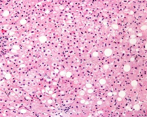 Human Liver Steatosis Stock Photo Image Of Photomicrograph 242799130