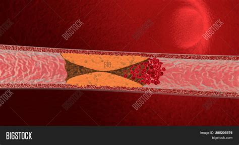 Blocked Blood Vessel Image And Photo Free Trial Bigstock