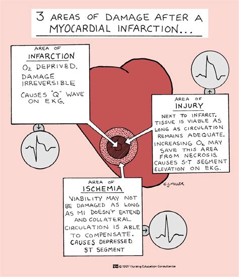 All For Nursing Ms Myocardial Infarction