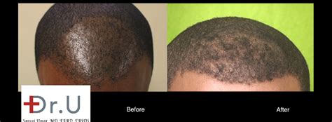 Achieve The Best Success Rates For African American Hair Transplants