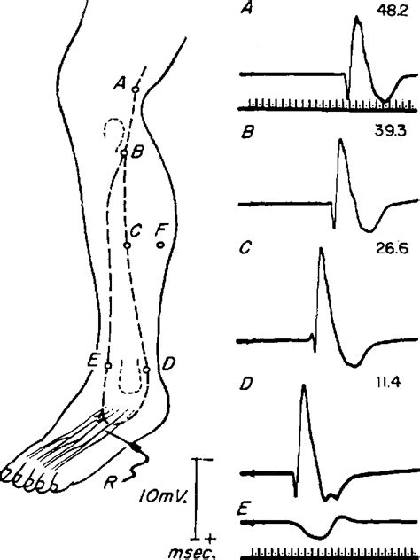 Figure 1 From The Accessory Deep Peroneal Nerve Semantic Scholar