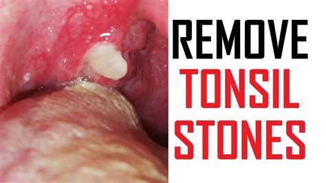 15 Ways To Remove Tonsil Stones At Home Tonsil Stones Treatment Youtube