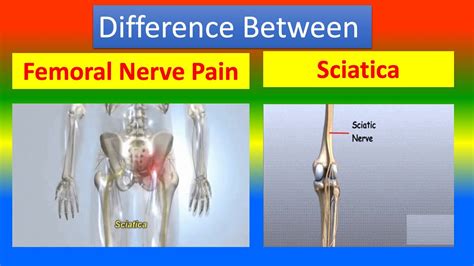 Difference Between Femoral Nerve Pain And Sciatica Youtube