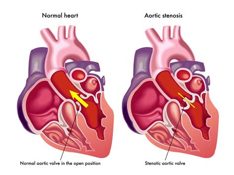 Facts About Aortic Stenosis Dr Peter Mikhail