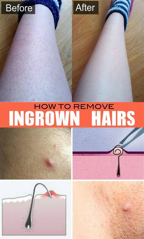 Best Thing To Do For Ingrown Hair How To Get Rid Of Ingrown Hairs Best Herbal Health