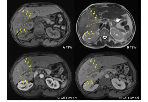 Infiltrative Hcc With Geographic Area Of Low T1 A And High T2 B