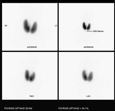 Thyroid Scintigraphy Tc M Radiology Reference Article