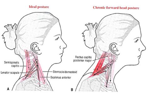 Forward Head Posture Muscles Pictures To Pin On Pinterest