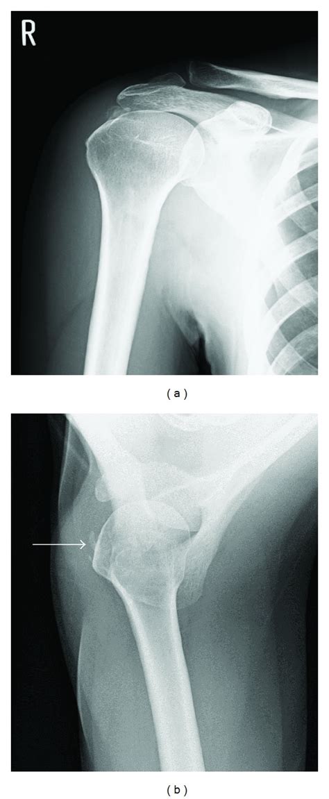 A And B Preoperative Radiographs Anteroposterior View Axillary