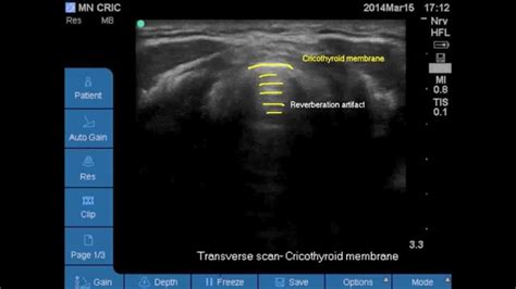 Ultrasound Airway Anatomy Vocal Cords Cricothyroid Membrane Cricoid
