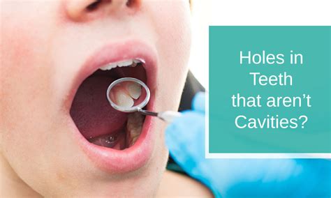 Holes In Teeth That Aren T Cavities Dental And Oral Care