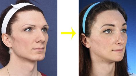 Before And After Facial Feminization Surgery Pics Facial Feminization