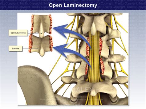 Open Laminectomy Trial Exhibits Inc