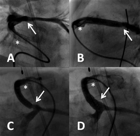 Effect Of Endovascular Stenting Of Right Ventricle To Pulmonary Artery