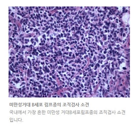 성인 동영상 야동 꿀잼 모두의 놀이터. 악성림프종, 혈액암 종류 중 하나…'항암치료 후 완치 확률은 ...