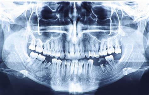 Dentist In Glendora Why Dental X Rays Are So Important
