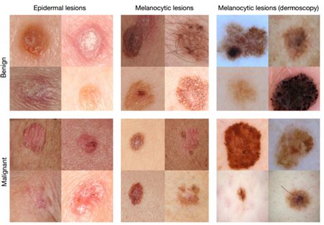 Deep Learning Algorithm Diagnoses Skin Cancer Better Than Human