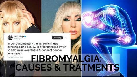Why Lady Gaga Is Raising Awareness For Fibromyalgia Patient Talk