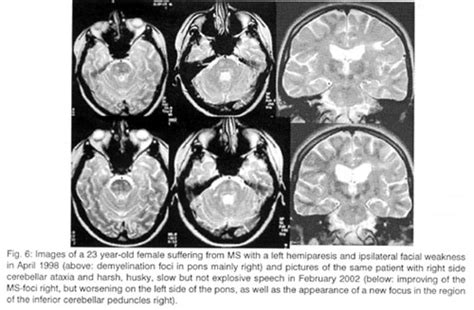 Brain Lesions January 2015