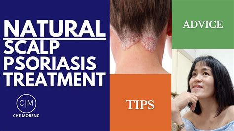 How To Treat Scalp Psoriasis Naturally Youtube