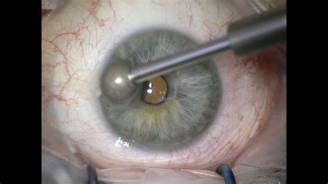 Search for similar articles you may search for similar articles that contain these same keywords or you may modify the. Alcohol debridement and diamond burr for recurrent corneal ...
