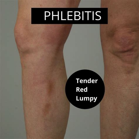 What Does Phlebitis Of The Leg Look Like With Pictures The Veincare Centre