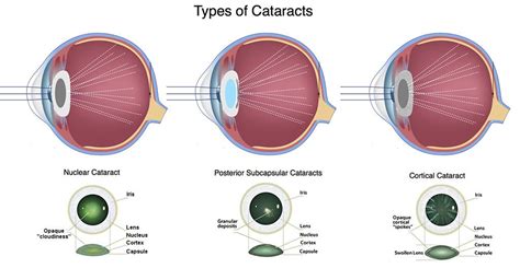 Cataract Diagnosis And Treatment Ma Northampton Eye