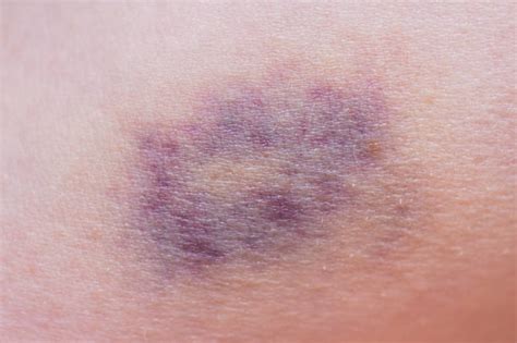 Royalty Free Bruise Pictures Images And Stock Photos Istock