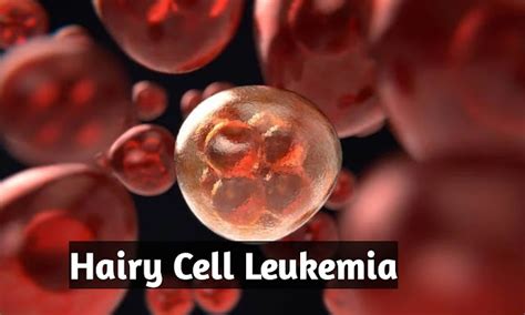 Hairy Cell Leukemia Symptoms And Life Expectancy