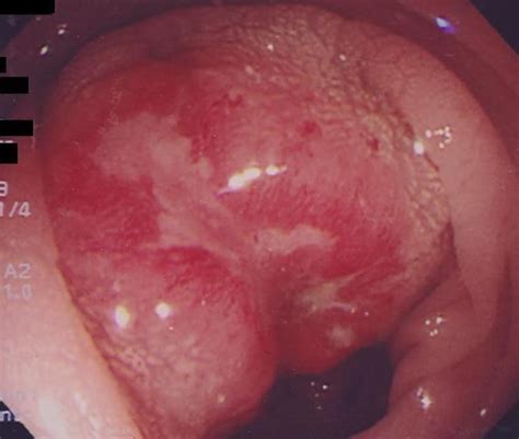 Advanced Small Cell Colon Carcinoma A Case Report Journal Of Medical