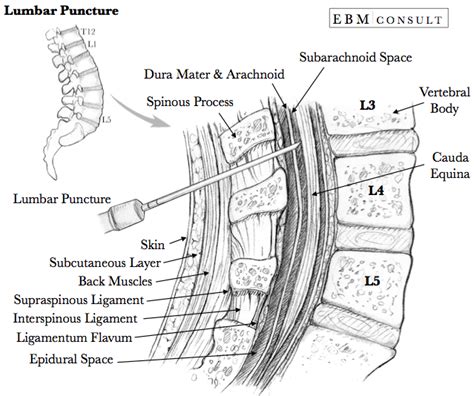 Procedure How To Do A Lumbar Puncture