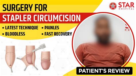 Stapler Circumcision Zsr Surgery Nawanshahrbest Hospital Bloodless