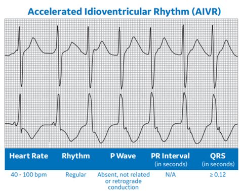 Arrhythmia Recognition Part 2 Clinical View